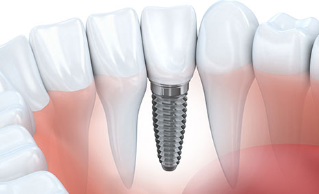 Diagram of a dental implant in the lower front part of mouth