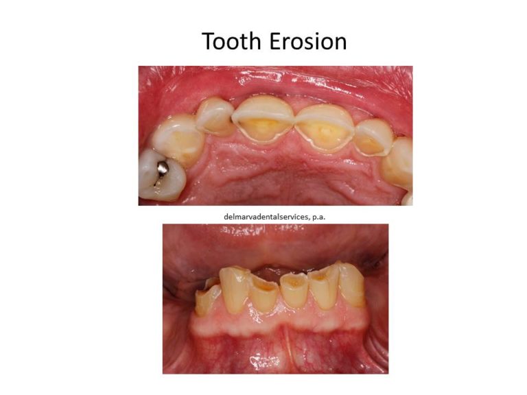 Harmful Dental Habits Salisbury MD