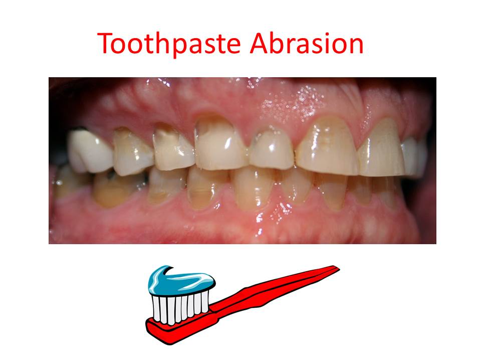 What Is Non Abrasive Toothpaste at Steven Duncan blog