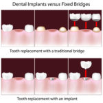 What’s the Difference Between Dental Implants and Dental Bridges?