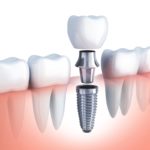 What Are My Tooth Replacement Options?