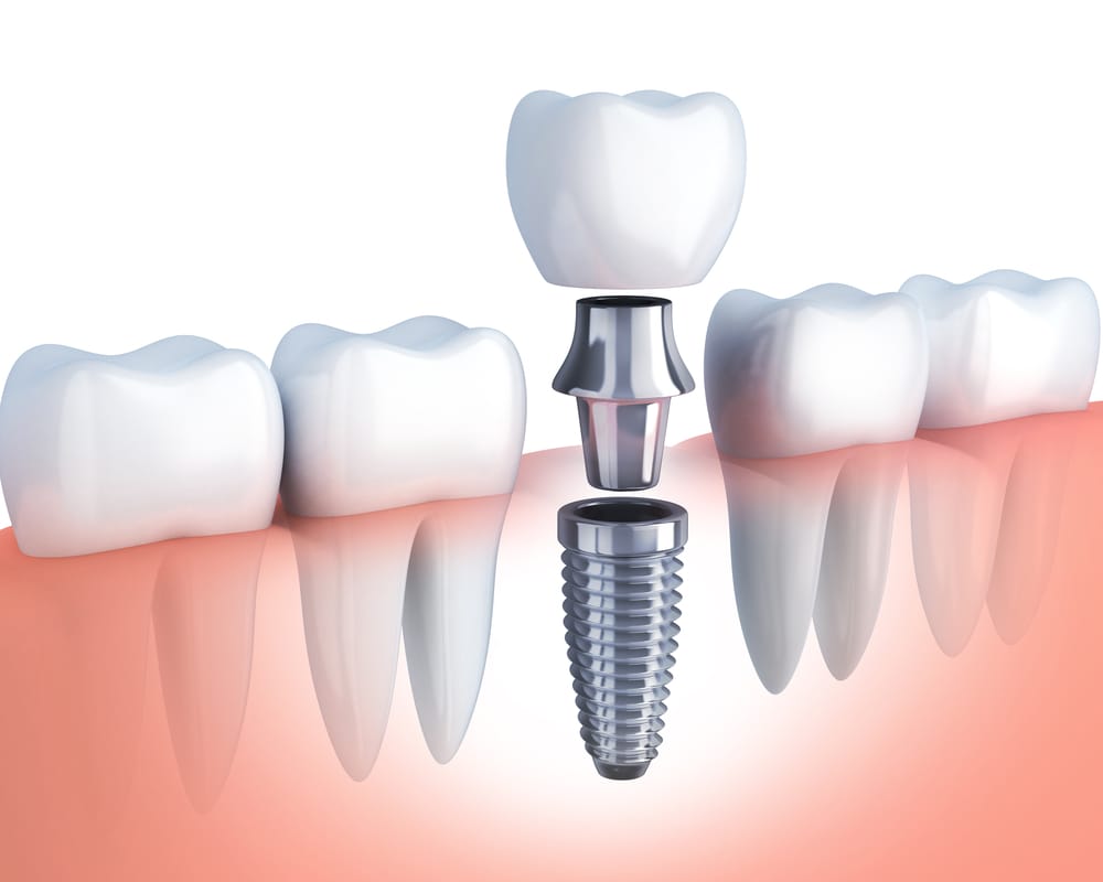 What Options Are Available For Missing Teeth?