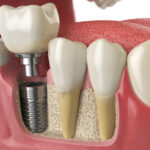 How to Prevent Bone Loss After Tooth Extraction